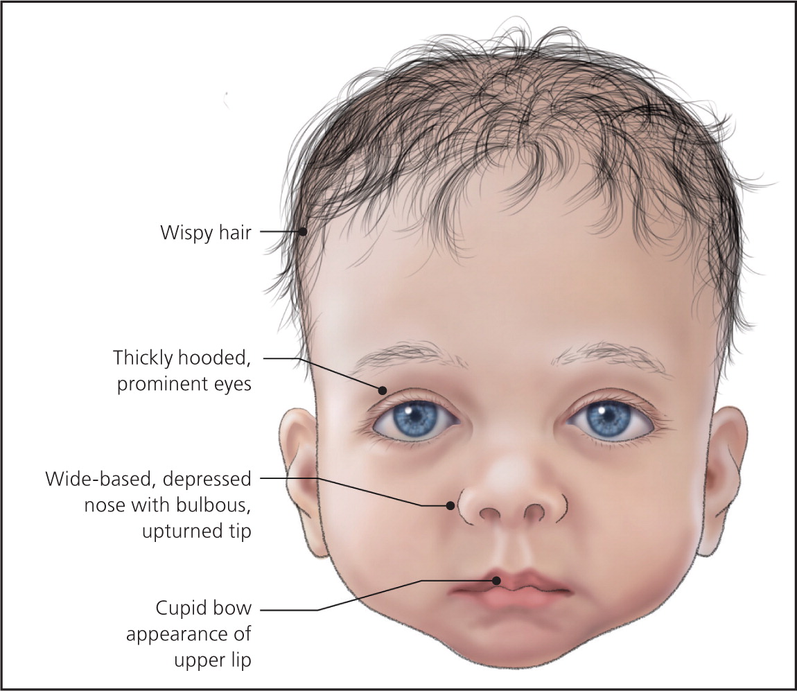 Celebrities with noonan syndrome